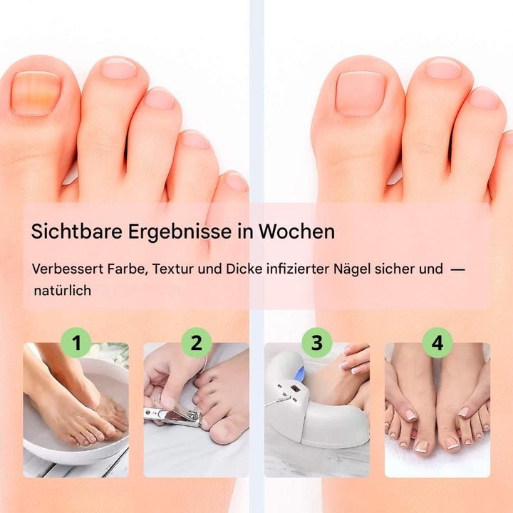 Lasergerät zur Entfernung von Nagelpilz