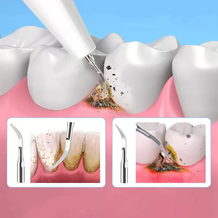 Lasergerät zur Entfernung von Nagelpilz